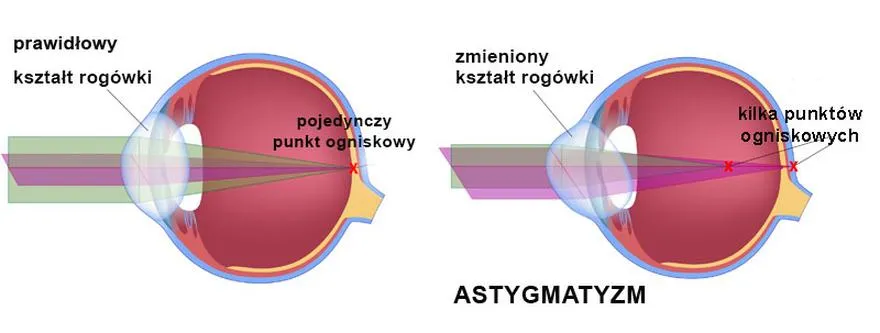 Wady wzroku w służbie wojskowej