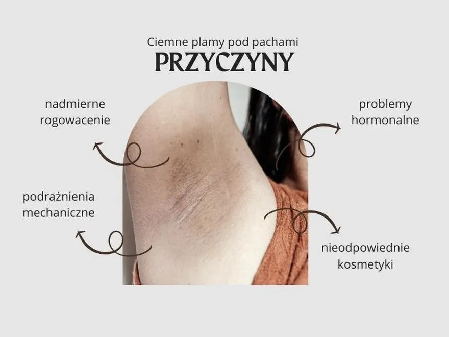 Żółte plamy domowe metody